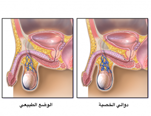 تأثير دوالي الخصية على الانتصاب