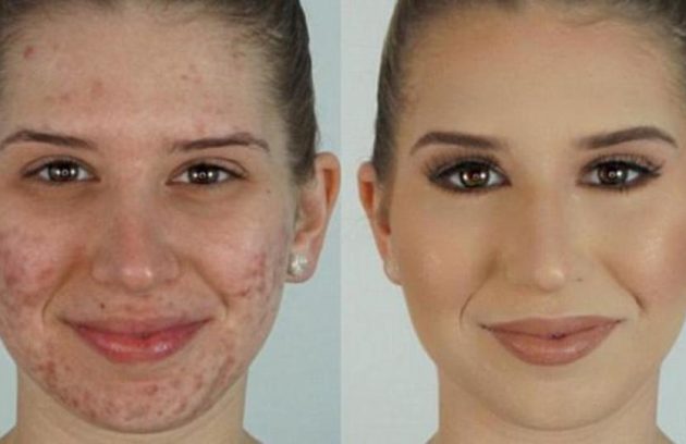 علاج الحبوب في الوجه واثارها