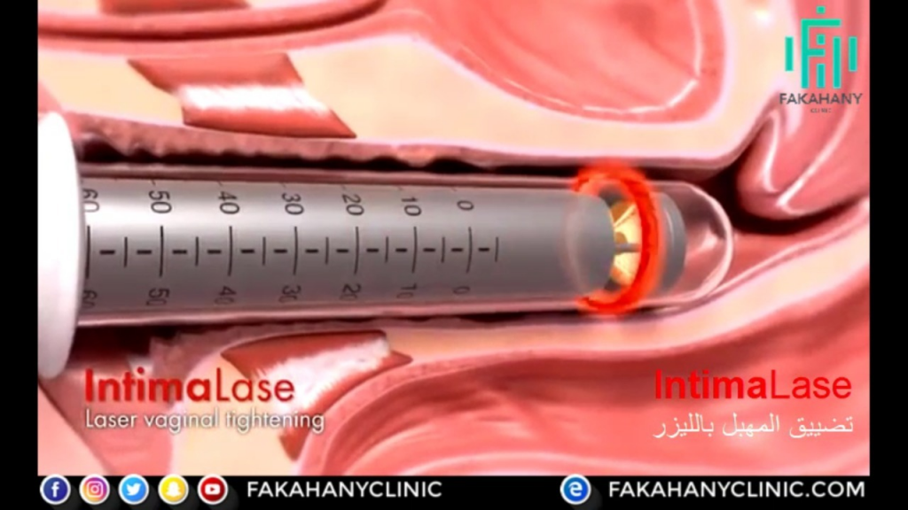 [ar]كيف تتم عملية تضييق المهبل بالصور Fakahany Clinic []