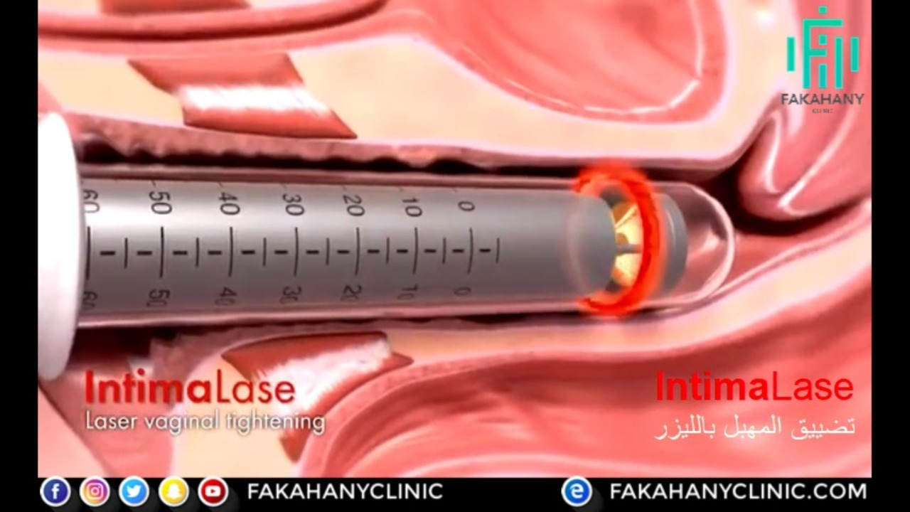 كيف تتم عملية تضييق المهبل بالليزر قالب الكهرباء