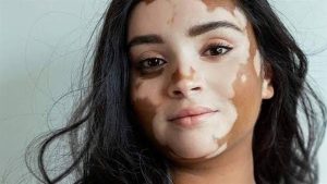 اخر علاج لمرضى البهاق