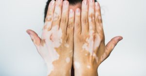 اسباب الاصابة بمرض البهاق