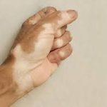 اسباب البرص