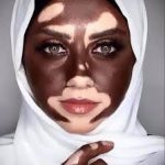 اضرار البهاق