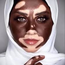 اضرار البهاق