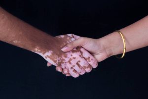 البرص والبهاق