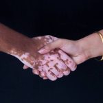 كريم البهاق الجديد
