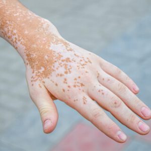 علاج البهاق عند الاطفال