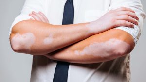 دواء للبهاق