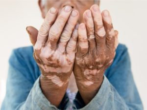 علاج مرض البهاق