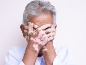 أسباب البهاق وعلاجه