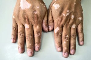 بالصور البهاق