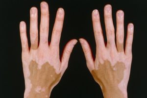 اسباب بهاق الجسم