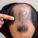 اعراض الصلع الوراثي عند النساء