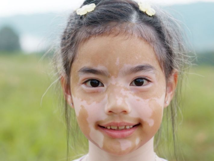 افضل علاج للبهاق عند الاطفال