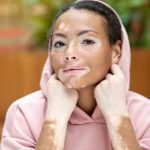 البهاق البرص