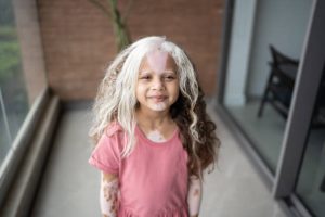 بداية البرص عند الاطفال