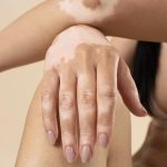 توحيد اللون البهاق