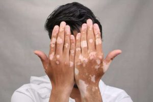 علاج البرص بالأعشاب