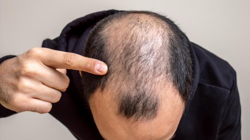 حل الصلع الوراثي