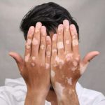 العلاج الطبيعي للبهاق